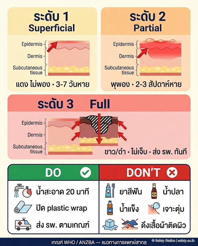 อินโฟกราฟิกเปรียบเทียบแผลไฟไหม้ระดับ 1-2-3 — สี ลักษณะ ความเจ็บ ชั้นผิวที่ถูกทำลาย